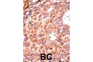 Formalin-fixed and paraffin-embedded human cancer tissue reacted with the primary antibody, which was peroxidase-conjugated to the secondary antibody, followed by AEC staining. (E2F1 antibody  (pSer337))