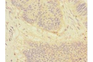 Immunohistochemistry of paraffin-embedded human colon cancer using ABIN7149768 at dilution of 1:100 (Desmocollin 1 antibody  (AA 480-690))