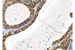 ABIN6260526 and ABIN6279316 at 1/100 staining Human ovarian cancer by IHC-P.