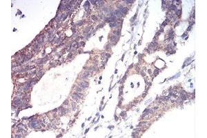 Immunohistochemical analysis of paraffin-embedded rectum cancer tissues using ALDH6A1 mouse mAb with DAB staining.