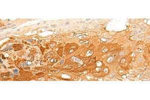 Immunohistochemistry of paraffin-embedded Human esophagus cancer tissue using DNAJC8 Polyclonal Antibody at dilution of 1:35(x200) (DNAJC8 antibody)