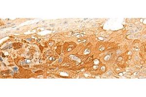 Immunohistochemistry of paraffin-embedded Human esophagus cancer tissue using DNAJC8 Polyclonal Antibody at dilution of 1:35(x200)