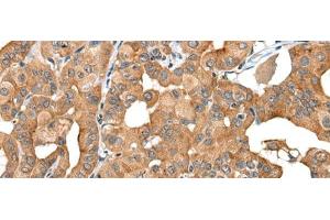 Immunohistochemistry of paraffin-embedded Human thyroid cancer tissue using INF2 Polyclonal Antibody at dilution of 1:40(x200) (INF2 antibody)