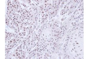 IHC-P Image Immunohistochemical analysis of paraffin-embedded Cal27 Xenograft, using PSR, antibody at 1:100 dilution. (JMJD6 antibody  (Center))