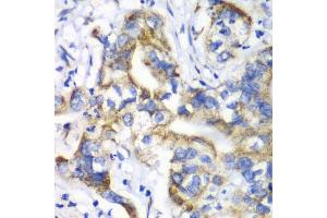Immunohistochemistry of paraffin-embedded human liver cancer using RPL9 antibody.