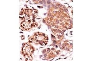 Formalin-fixed and paraffin-embedded human cancer tissue reacted with the primary antibody, which was peroxidase-conjugated to the secondary antibody, followed by AEC staining. (ABL2 antibody  (pTyr393, pTyr439))