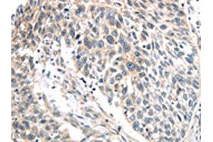 The image on the left is immunohistochemistry of paraffin-embedded Human lung cancer tissue using ABIN7191116(IQGAP2 Antibody) at dilution 1/40, on the right is treated with synthetic peptide. (IQGAP2 antibody)
