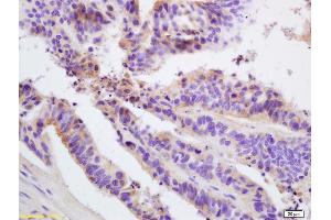 Formalin-fixed and paraffin embedded human colon carcinoma labeled with Rabbit Anti FIS1/TTC11 Polyclonal Antibody, Unconjugated (ABIN872461) at 1:200 followed by conjugation to the secondary antibody and DAB staining (Fission 1 antibody  (AA 55-152))