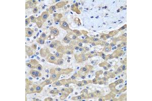 Immunohistochemistry of paraffin-embedded human liver cancer using GFM1 antibody at dilution of 1:100 (40x lens).
