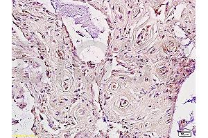 Formalin-fixed and paraffin embedded human rectal carcinoma labeled Anti-LDL receptor Polyclonal Antibody, Unconjugated (ABIN672111) at 1:200, followed by conjugation to the secondary antibody and DAB staining (LDLR antibody  (AA 781-860))