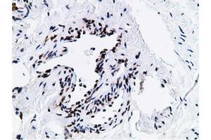 Immunohistochemical staining of paraffin-embedded Carcinoma of Human kidney tissue using anti-NT5DC1 mouse monoclonal antibody. (NT5DC1 antibody)