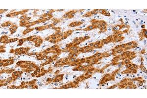 Immunohistochemistry of paraffin-embedded Human liver cancer tissue using Claudin 10 Polyclonal Antibody at dilution 1:50