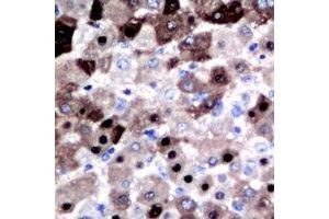 Immunohistochemical analysis of DGK iota staining in human liver cancer formalin fixed paraffin embedded tissue section. (DGKI antibody  (C-Term))