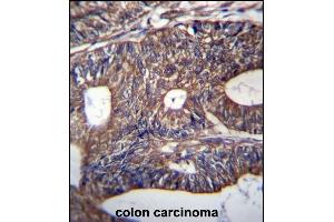 UQCRB Antibody (Center) (ABIN656932 and ABIN2846122) immunohistochemistry analysis in formalin fixed and paraffin embedded human colon carcinoma followed by peroxidase conjugation of the secondary antibody and DAB staining. (UQCRB antibody  (AA 19-47))