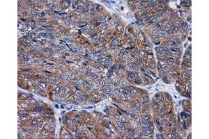 Immunohistochemical staining of paraffin-embedded Adenocarcinoma of colon tissue using anti-RALBP1 mouse monoclonal antibody.