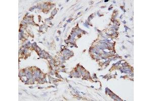 IHC-P: OPN antibody testing of human breast cancer tissue (Osteopontin antibody  (N-Term))
