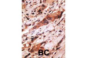Formalin-fixed and paraffin-embedded human cancer tissue reacted with CD82 polyclonal antibody  , which was peroxidase-conjugated to the secondary antibody, followed by AEC staining. (CD82 antibody  (C-Term))