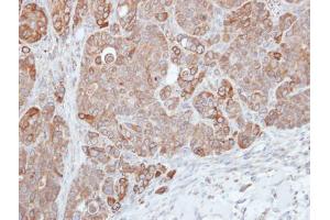 IHC-P Image Immunohistochemical analysis of paraffin-embedded SW480 xenograft, using HPS3, antibody at 1:500 dilution. (HPS3 antibody  (C-Term))