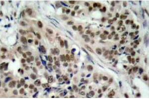 Immunohistochemistry (IHC) analyzes of p-FoxO1 antibody in paraffin-embedded human breast carcinoma tissue. (FOXO1 antibody  (pSer256))