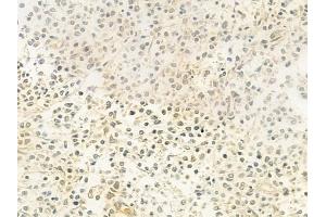 ABIN6263588 and ABIN6279411 at 1/100 staining human Hodgkin lymphoma by IHC-P. (NEIL2 antibody  (Internal Region))