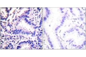 Immunohistochemistry analysis of paraffin-embedded human lung carcinoma tissue, using Synuclein gamma Antibody. (SNCG antibody  (AA 78-127))