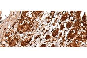 Immunohistochemistry of paraffin-embedded Human breast cancer tissue using UBE2V1 Polyclonal Antibody at dilution of 1:30(x200) (UBE2V1 antibody)