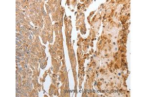 Immunohistochemistry of Human cervical cancer using NPY1R Polyclonal Antibody at dilution of 1:30 (NPY1R antibody)