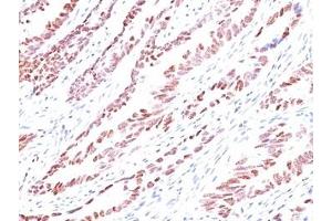 Formalin-fixed, paraffin-embedded human colon carcinoma stained with p57 antibody (KP10). (P57 antibody)
