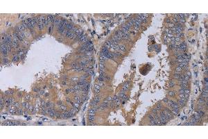 Immunohistochemistry of paraffin-embedded Human colon cancer tissue using MKKS Polyclonal Antibody at dilution 1:50 (MKKS antibody)