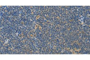 Immunohistochemistry of paraffin-embedded Human lymphoma using ASPA Polyclonal Antibody at dilution of 1:80 (ASPA antibody)