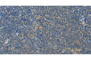 Immunohistochemistry of paraffin-embedded Human lymphoma using ASPA Polyclonal Antibody at dilution of 1:80