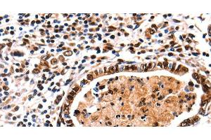 Immunohistochemistry of paraffin-embedded Human stomach cancer tissue using DNMT3A Polyclonal Antibody at dilution 1:65 (DNMT3A antibody)