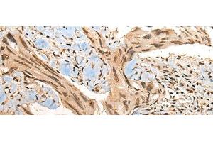 Immunohistochemistry of paraffin-embedded Human breast cancer tissue using CBFB Polyclonal Antibody at dilution of 1:40(x200) (CBFB antibody)