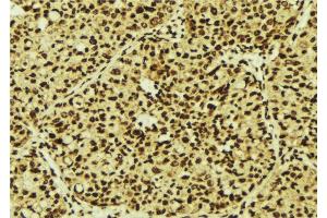ABIN6277246 at 1/100 staining Human breast cancer tissue by IHC-P. (TNK2 antibody  (C-Term))