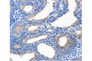 Immunohistochemical analysis of paraffin-embedded Human cervical cancer tissue using at dilution 1/25. (CTLA4 antibody  (C-Term))