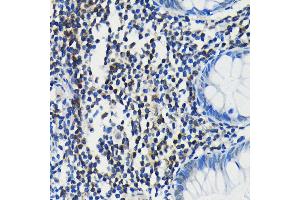 Immunohistochemistry of paraffin-embedded human colon using PIM1 antibody (ABIN7269375) at dilution of 1:100 (40x lens). (PIM1 antibody)