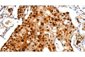 Immunohistochemistry of paraffin-embedded Human breast cancer using Proliferating Cell Nuclear Antigen Polyclonal Antibody at dilution of 1:44 (PCNA antibody)