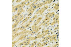 Immunohistochemistry of paraffin-embedded human liver cancer using HSPA9 antibody (ABIN5970207) at dilution of 1/100 (40x lens). (HSPA9 antibody)