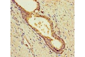 Immunohistochemistry of paraffin-embedded human prostate cancer using ABIN7145605 at dilution of 1:100 (MUTED antibody  (AA 2-187))