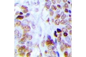 Immunohistochemical analysis of Dyskerin staining in human prostate cancer formalin fixed paraffin embedded tissue section. (DKC1 antibody)
