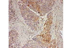 IHC-P: GRB7 antibody testing of human oesophagus squama cancer tissue (GRB7 antibody  (Middle Region))