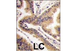 Formalin-fixed and paraffin-embedded human lung carcinoma tissue reacted with P38 delta antibody (C-term), which was peroxidase-conjugated to the secondary antibody, followed by DAB staining. (MAPK13 antibody  (C-Term))