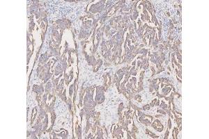 IHC analysis of Cytokeratin 19 using anti-Cytokeratin 19 antibody (ABIN3043288). (Cytokeratin 19 antibody  (C-Term))