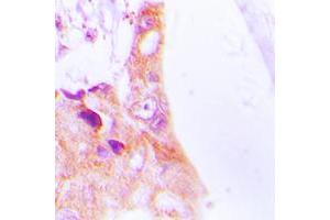 Immunohistochemical analysis of Cytokeratin 8 staining in human lung cancer formalin fixed paraffin embedded tissue section. (KRT8 antibody  (Center))
