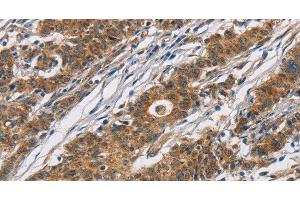 Immunohistochemistry of paraffin-embedded Human gasrtic cancer tissue using CYP21A2 Polyclonal Antibody at dilution 1:60 (CYP21A2 antibody)