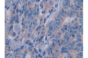 Detection of SEMA3A in Human Colorectal cancer Tissue using Polyclonal Antibody to Semaphorin 3A (SEMA3A) (SEMA3A antibody  (AA 580-664))