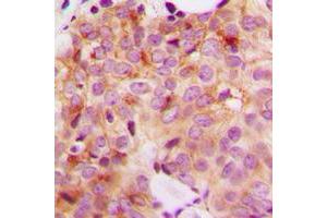 Immunohistochemical analysis of GAK staining in human breast cancer formalin fixed paraffin embedded tissue section. (GAK antibody  (N-Term))