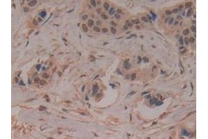 Detection of LILRB2 in Human Breast cancer Tissue using Polyclonal Antibody to Leukocyte Immunoglobulin Like Receptor Subfamily B, Member 2 (LILRB2)