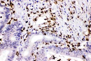 Cathepsin G was detected in paraffin-embedded sections of human intestinal cancer tissues using rabbit anti- Cathepsin G Antigen Affinity purified polyclonal antibody (Catalog # ) at 1 ? (Cathepsin G antibody  (AA 25-252))