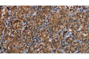 Immunohistochemistry of paraffin-embedded Human thyroid cancer tissue using LLGL1 Polyclonal Antibody at dilution 1:40 (LLGL1 antibody)